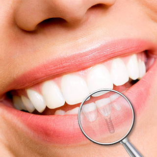 Impianti-dentali_Realizzazione-impianti-in-Bulgaria_Puma-Services-Europe